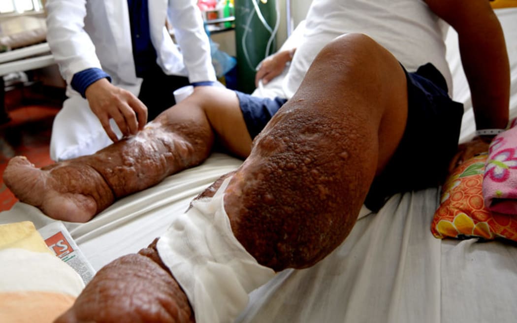 Mass drug administration for filariasis to start
